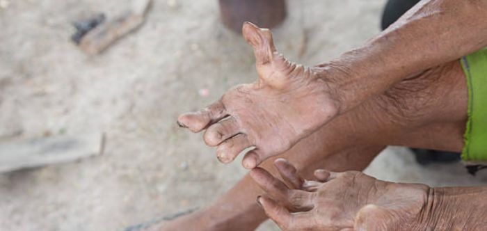 leprosy-awareness