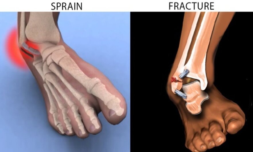 Broken Bone vs. Sprained Bone